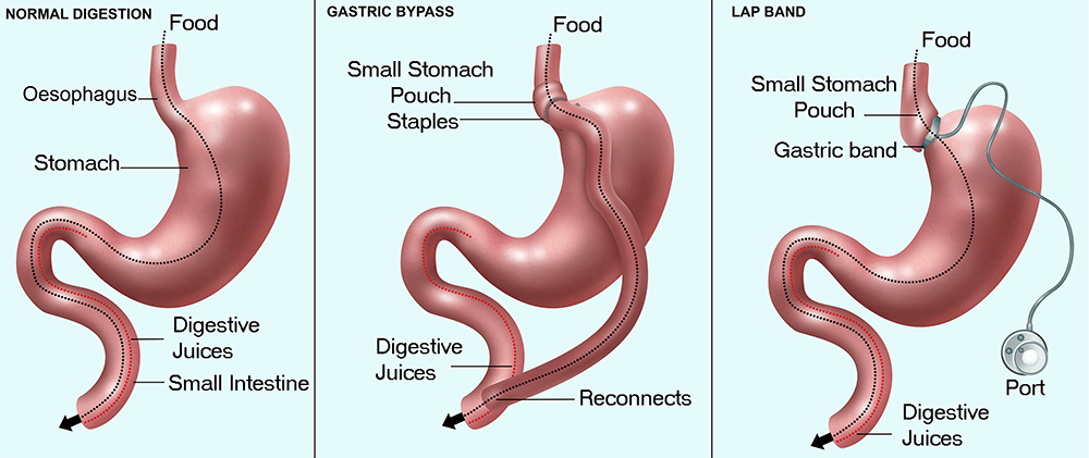 guide-to-bariatric-surgery-70c984