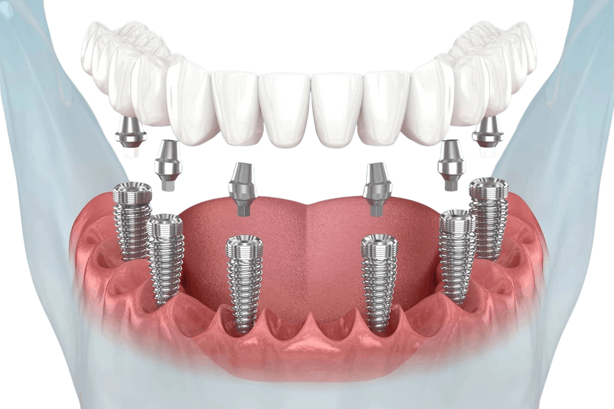 https://en.ihchealthylife.com/wp-content/uploads/2026/02/ALL-ON-6-DIS-IMPLANT-1.png
