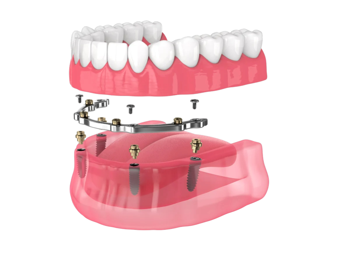 https://en.ihchealthylife.com/wp-content/uploads/2026/02/Understanding-Full-Mouth-Dental-Restoration-Comparing-All-On-4-Technique-With-Others_1745736531-1162x872-1.png
