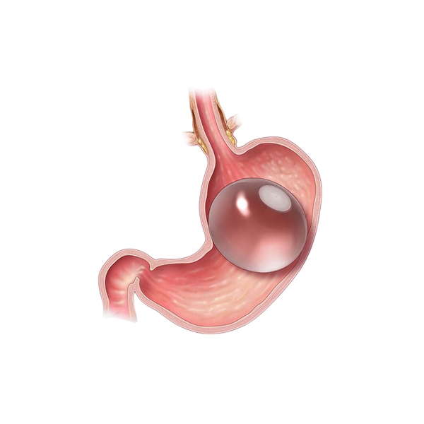 https://en.ihchealthylife.com/wp-content/uploads/2026/02/gastric-balloon-Photoroom.png
