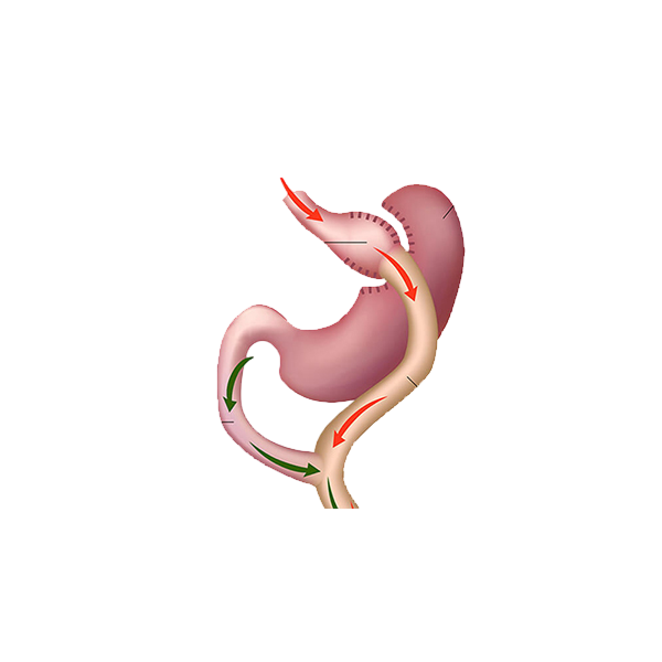 https://en.ihchealthylife.com/wp-content/uploads/2026/02/gastric_by_pass-Photoroom.png
